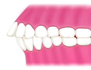 出っ歯｜相馬市の菅野歯科医院