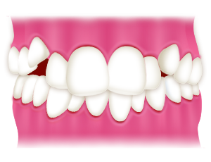 八重歯・叢生｜相馬市の菅野歯科医院